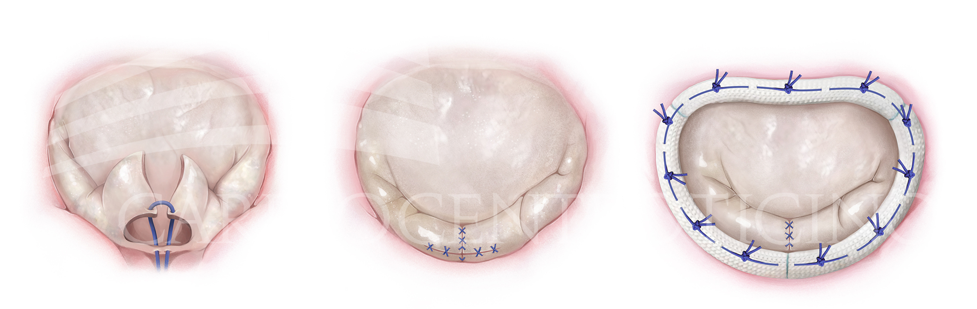 The Cardinal adjustable annuloplasty ring system. ( A ) The Cardinal... |  Download Scientific Diagram