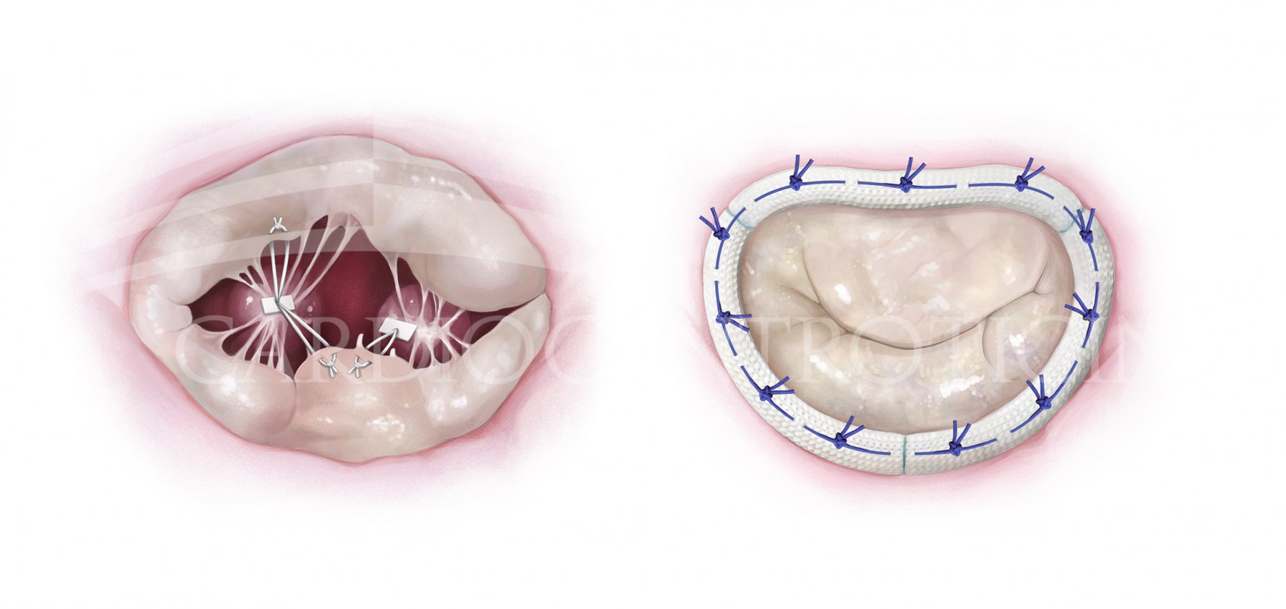 Mitral annuloplasty ring - Memo 3D ReChord - LivaNova